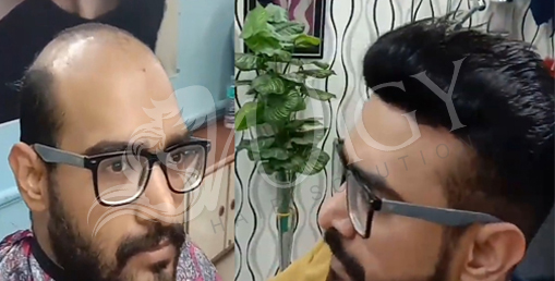 Non Surgical Hair Replacement Service in Delhi